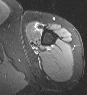 Figure 5 for case Tear of tendon of long head of biceps brachii sp tenodesis (RID1944)